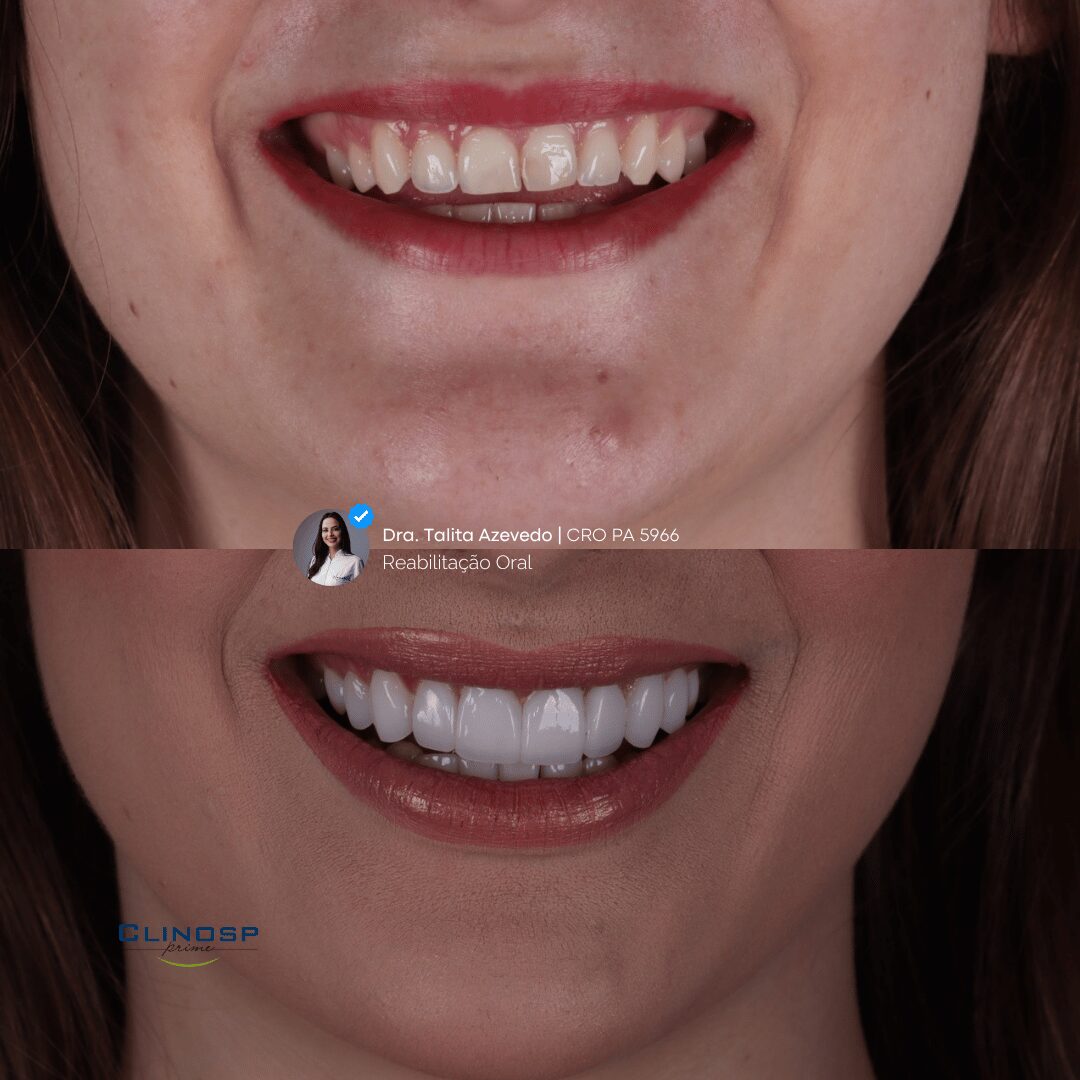 PAISAGEM - ANTES E DEPOIS FACETAS RESINA CLINOSP PRIME