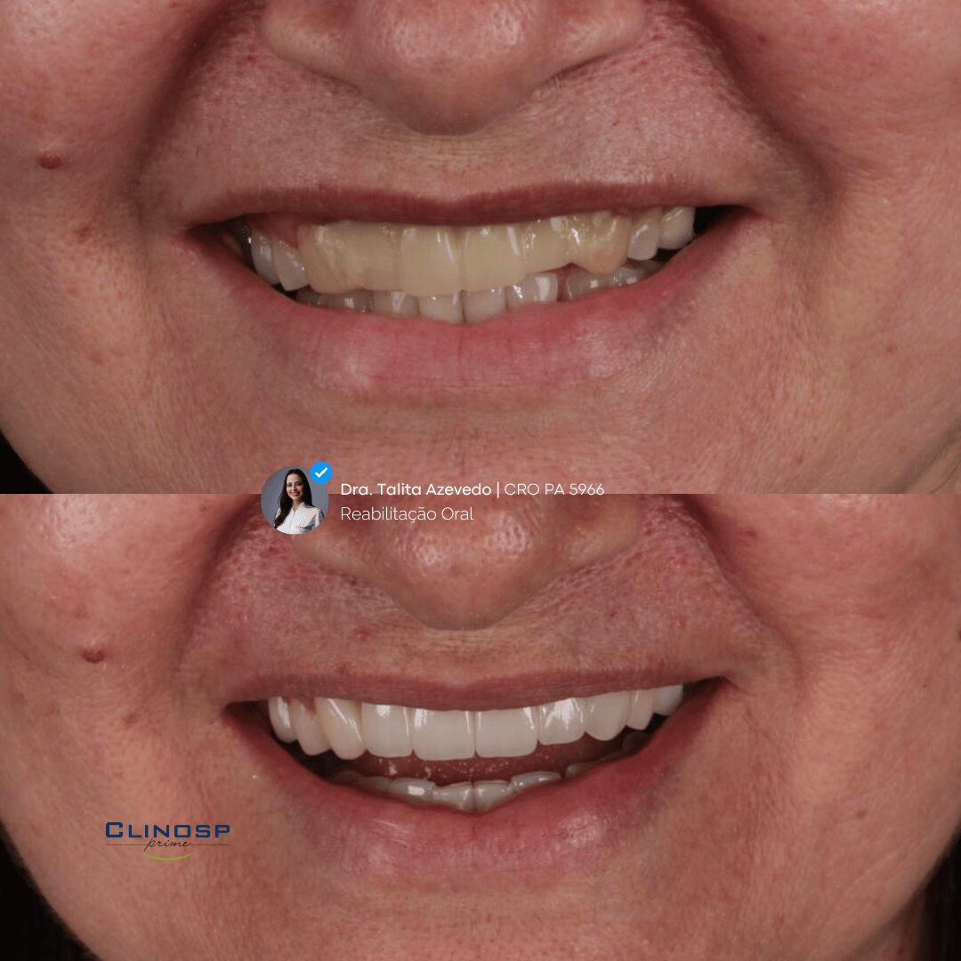 PAISAGEM - ANTES E DEPOIS FACETAS 3