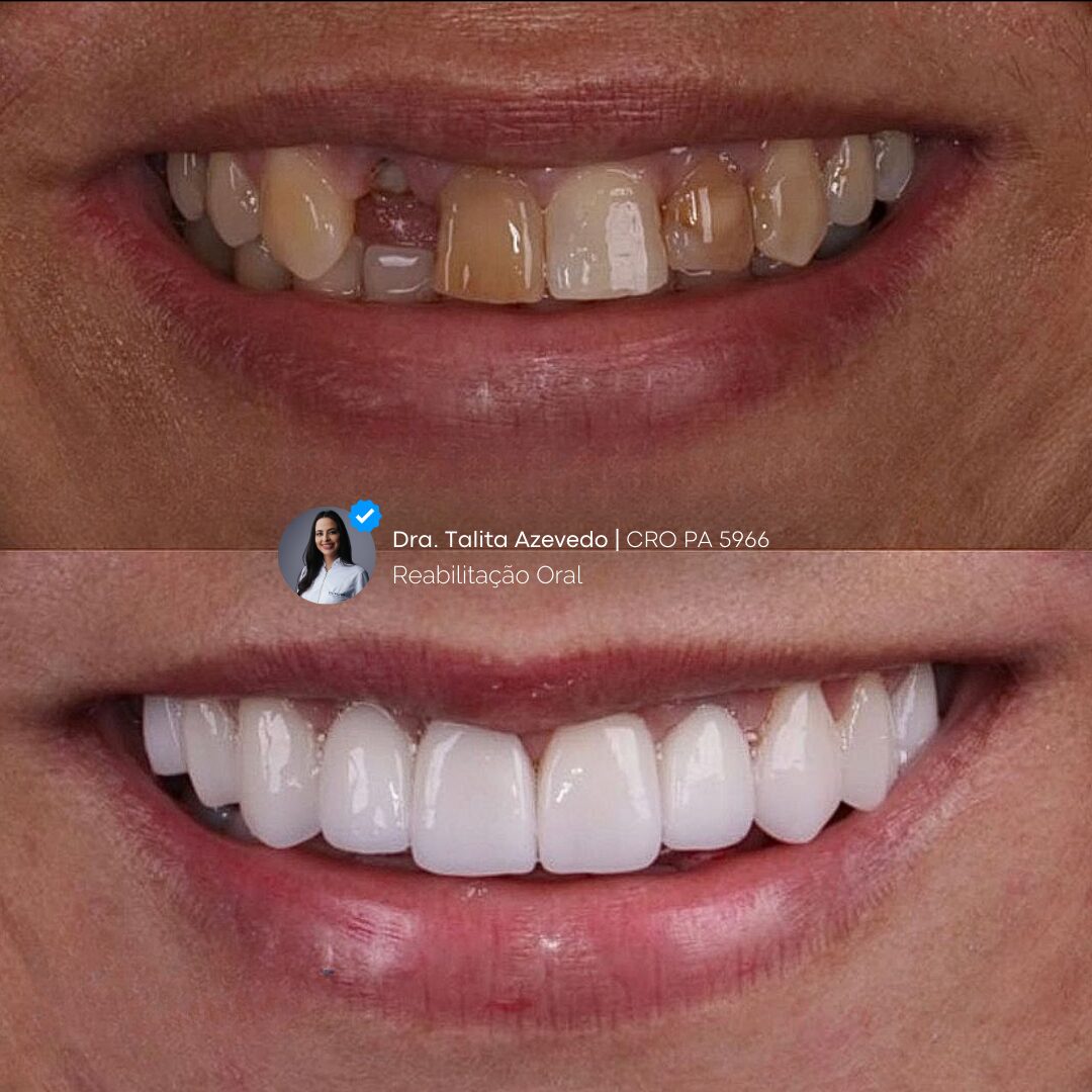 FOTO DE CASO ANTES E DEPOIS DE FACETAS EM CERAMICA / FACETAS EM PORCELANA