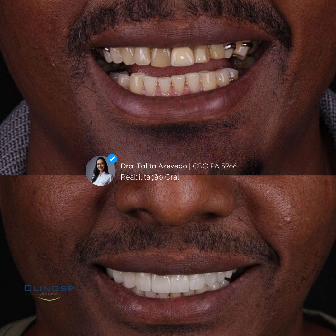 FOTO DE CASO ANTES E DEPOIS DE FACETAS EM CERAMICA / FACETAS EM PORCELANA