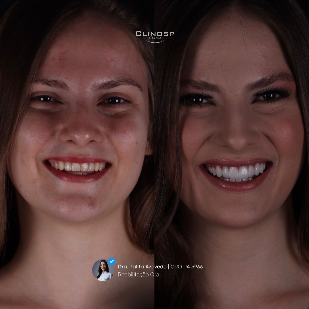 FOTO DE CASO ANTES E DEPOIS DE FACETAS EM CERAMICA / FACETAS EM PORCELANA