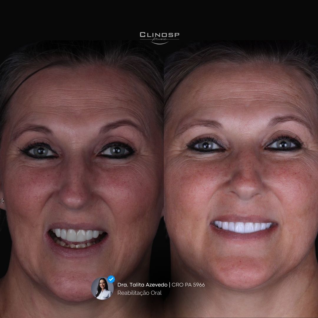 FOTO DE CASO ANTES E DEPOIS DE FACETAS EM CERAMICA / FACETAS EM PORCELANA