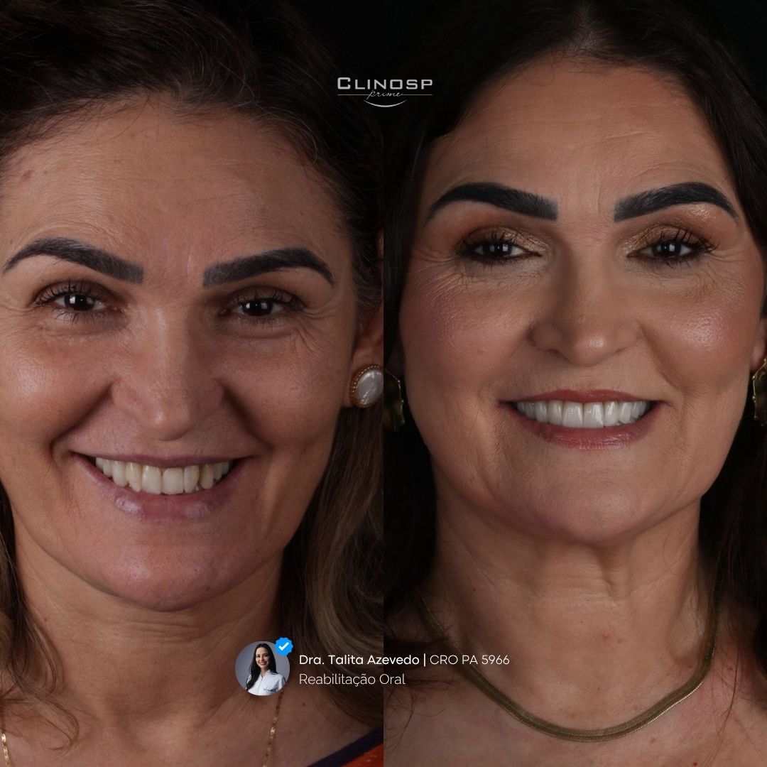 FOTO DE CASO ANTES E DEPOIS DE FACETAS EM CERAMICA / FACETAS EM PORCELANA
