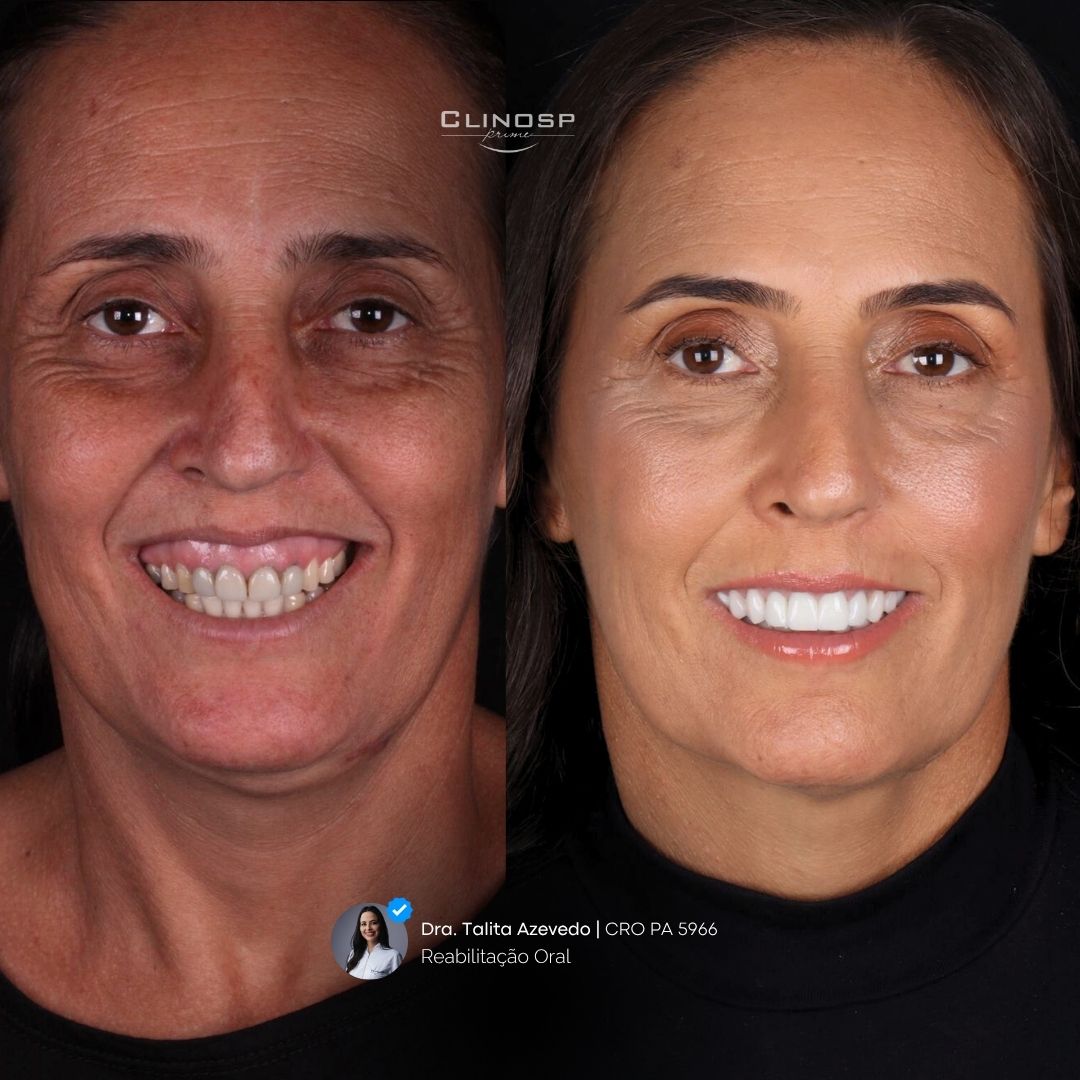 FOTO DE CASO ANTES E DEPOIS DE FACETAS EM CERAMICA / FACETAS EM PORCELANA